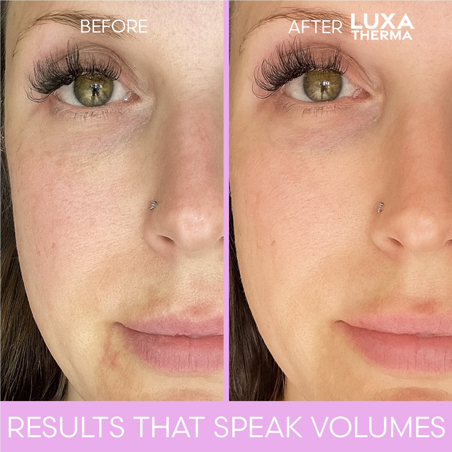 Luxa Therma Face + Neck Red Light Kit – Bundle & Save