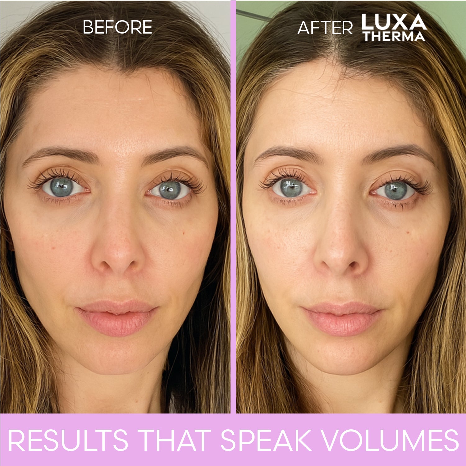 Luxa Therma Face + Neck Red Light Kit – Bundle & Save