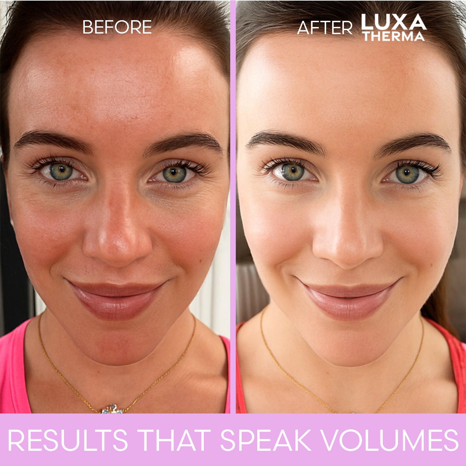 Luxa Therma Face + Neck Red Light Kit – Bundle & Save