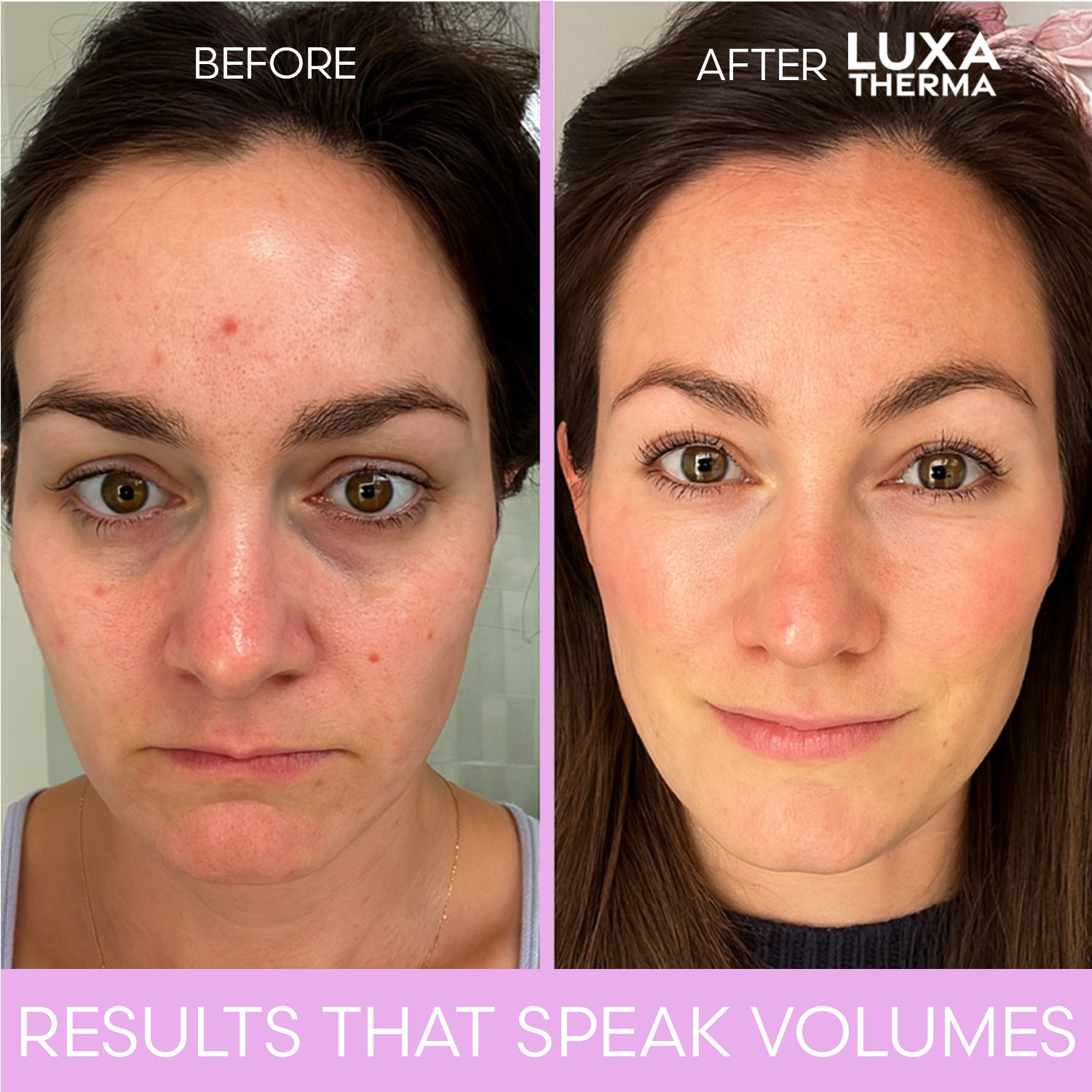 Luxa Therma Face + Neck Red Light Kit – Bundle & Save