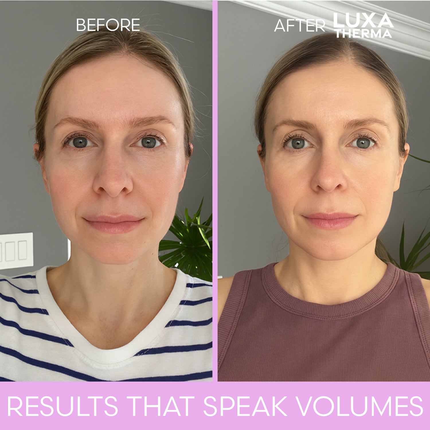 Luxa Therma Face + Neck Red Light Kit – Bundle & Save
